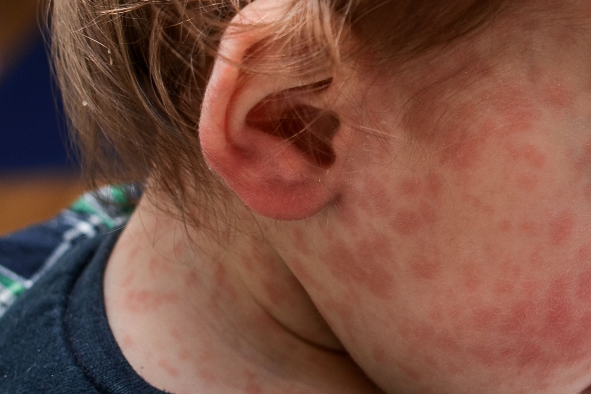 Ante la confirmación de un caso de sarampión, Salud convocó a comisión de vigilancia